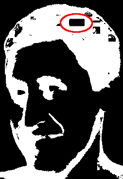 Juri Linkov with microchip in head circled in red